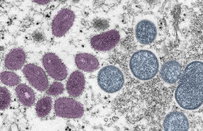 Monkeypox virus diagnosed in a child in the Netherlands for the first time | NOW